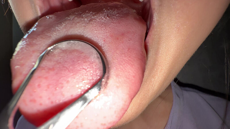 【個人撮影】谷田かりなの舌ブラシで「汚舌苔」採取 画像13