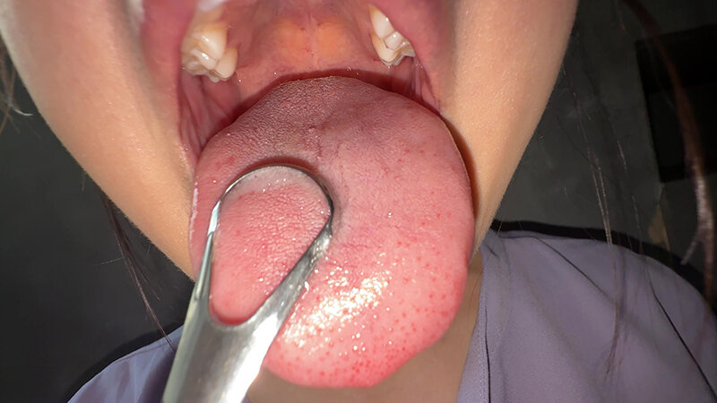 【個人撮影】谷田かりなの舌ブラシで「汚舌苔」採取 画像14